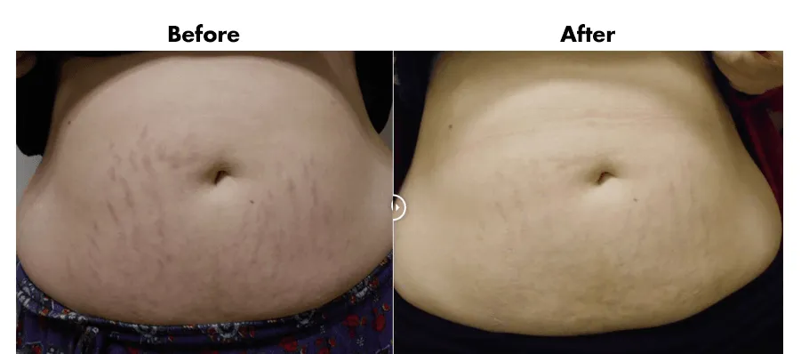 Stratamark Stretch Mark Gel 20g